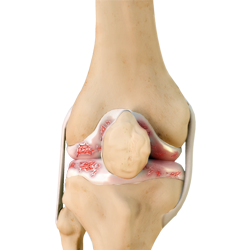 Artritic Knee