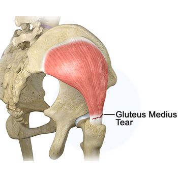 Gluteus Medius Tear