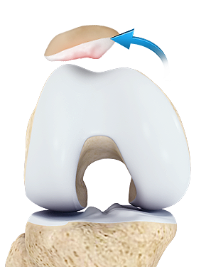 Patellar Instability