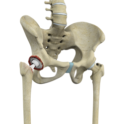 Rivision Hip Replacement