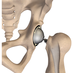 Total Hip Replacement